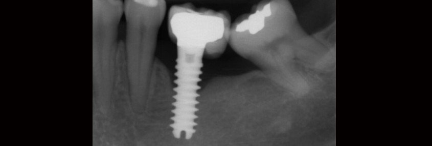 Cómo cuidar los implantes dentales en 5 pasos.jpg